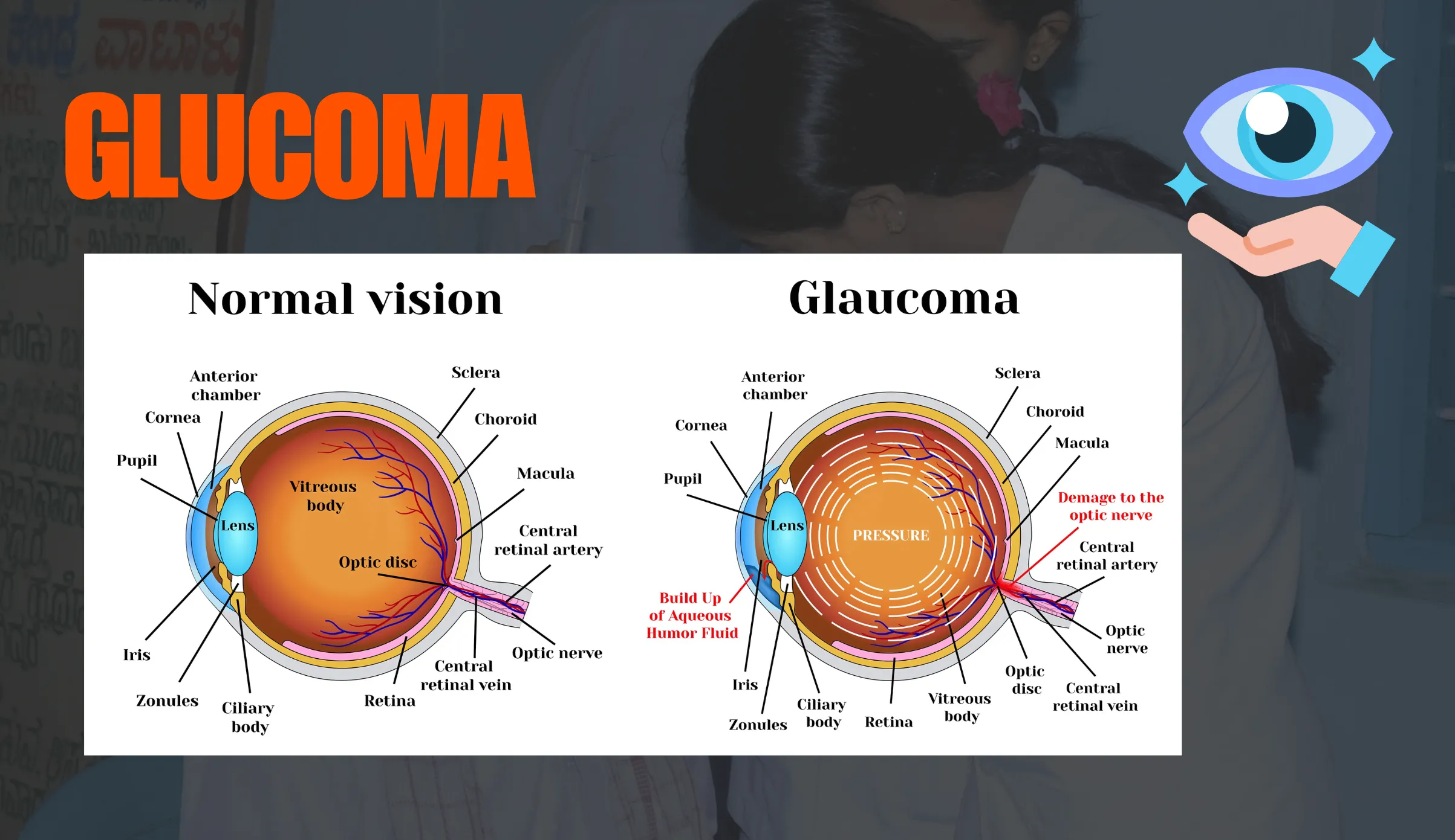 Glaucoma-Management